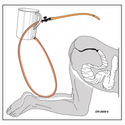 Anatomische Skizze: Nahezu leeres absteigendes Colon und Querdarm nach der Entleerung eines Zwei Liter-Einlaufs.