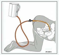 Anatomische Skizze, Knie-Ellenbogen-Lage mit tief eingeführtem 11 mm-Ruesch-Darmrohr gegen Ende eines Einlaufs von 2 Liter.