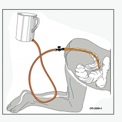 Anatomie-Skizze: Rectum, Sigmoid, und absteigender Colon in Knie-Ellenbogen-Lage, mit eingeführtem 11-mm Ruesch-Darmrohr