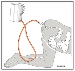 Anatomie-Skizze: Rectum, Sigmoid, absteigender Colon in Knie-Ellenbogen-Lage vor dem Einlauf