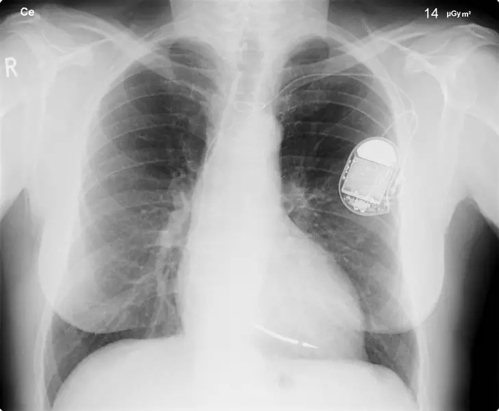 Datei:Herzschrittmacher auf Röntgenbild.jpg